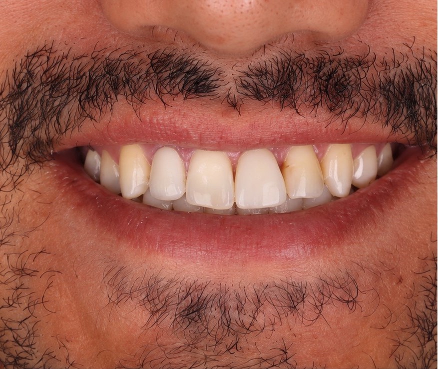 Smile Suite case 2 before