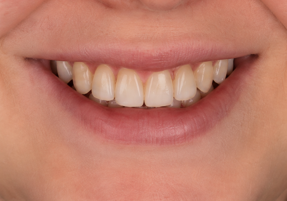 Smile Suite case 1 after