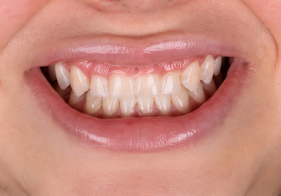 Smile Suite case 1 before