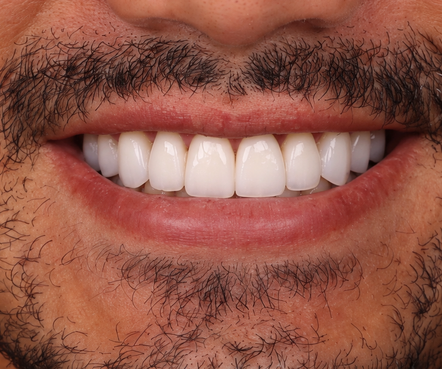 Smile Suite case 2 after
